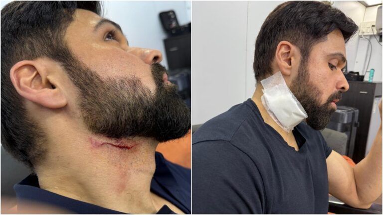 Emraan Hashmi Injured During Action Scene on G2 Set